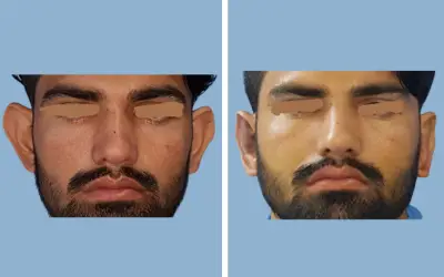 Before and After