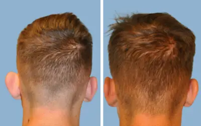Before and After