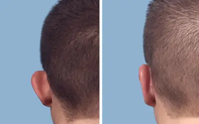 Before and After
