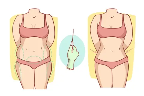 image explaining transformation possible with Liposuction