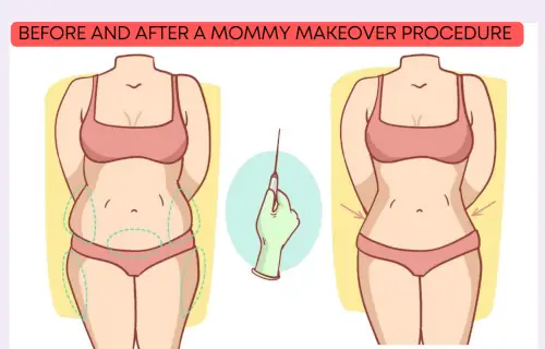 Mommy Makeover Before and After representative picture