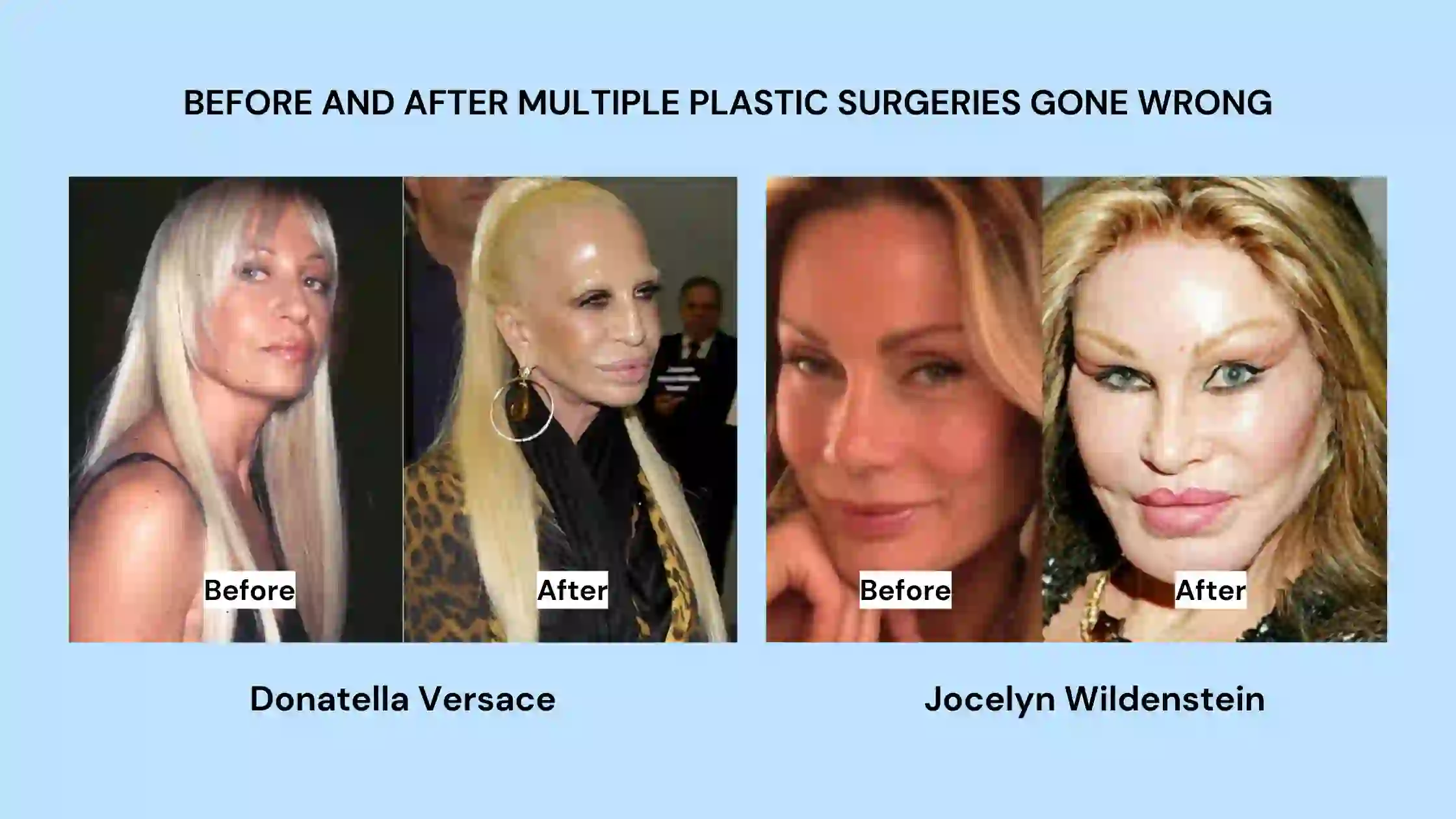 before and after multiple plastic surgeries gone wrong