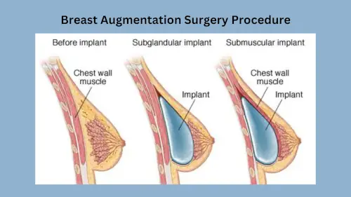 breast-augmentation-procedure