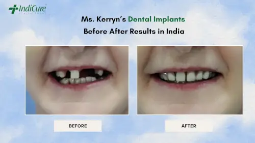 dental-implants-in-india-treatment-results dental-implants-in-india-treatment-results