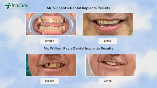 dental-implants-treatment-in-india-before-after dental-implants-treatment-in-india-before-after