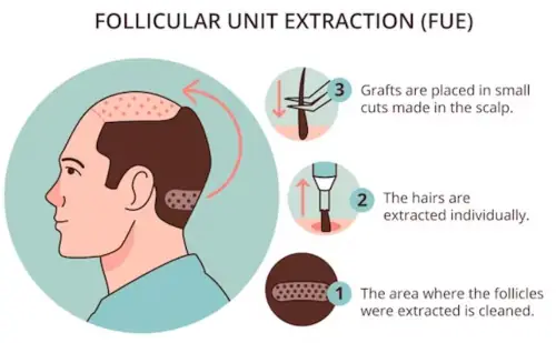 Follicular Unit Extraction (FUE) explained