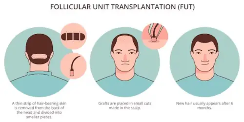 Follicular Unit Transplant (FUT) explained