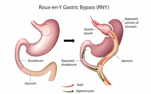 gastric-bypass-surgery