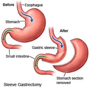 gastric-sleeve-surgery