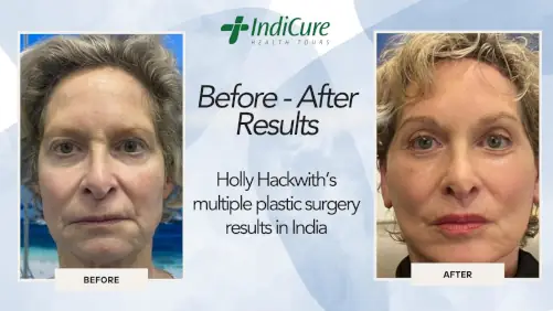 Holly Hackwith’s multiple plastic surgery results in India