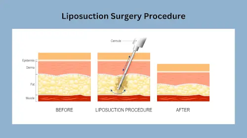 liposuction-surgery-procedure