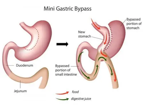 mini-gastric-bypass-surgery