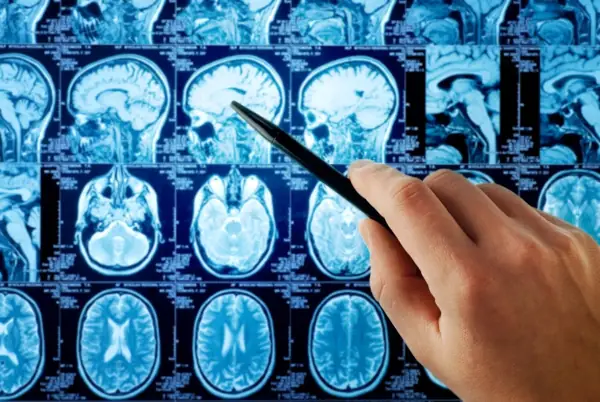 DBS neurosurgery expert reading a brain scan