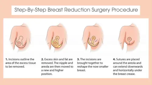 step-by-step-breast-reduction