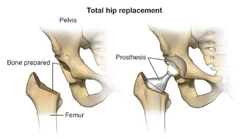 Total Hip Replacement Surgery Procedure