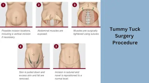 tummy-tuck-surgery-procedure