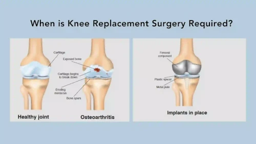 When is Knee Replacement Surgery Required?