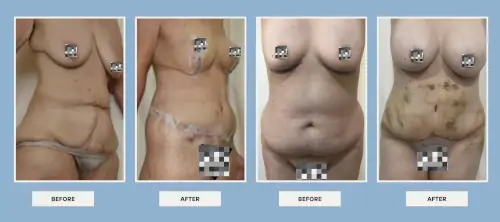 body-procedures-before-after-4