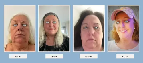 facial-procedures-before-after-1